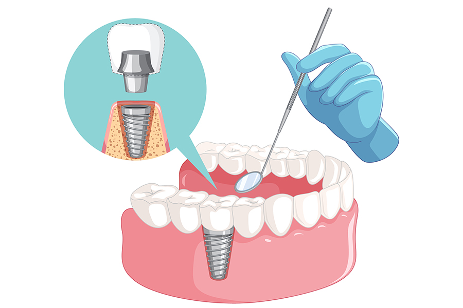 Do Dental Implants Hurt? (What you should know about them)