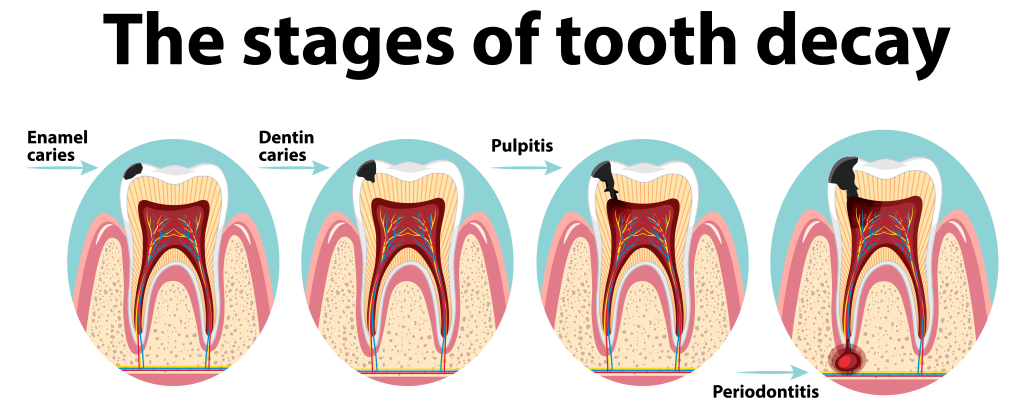 Stages of Tooth Decay